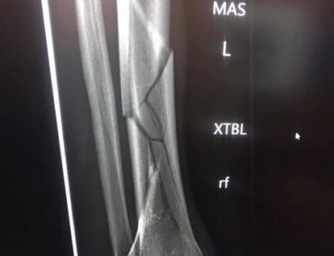 Bossche’s fracture